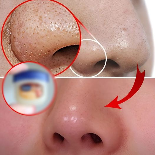 Remove blackheads on your nose with just a mixture of Vaseline and this cheap and easy-to-find ingredient