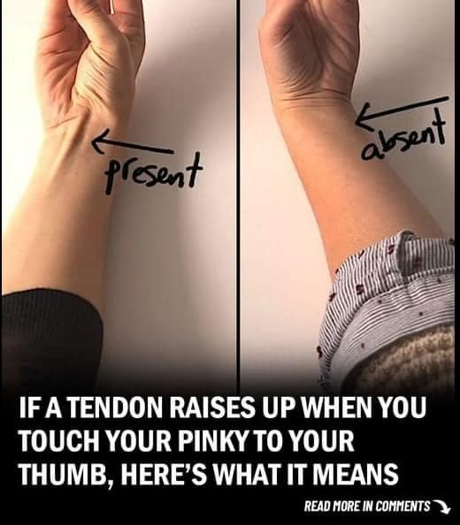 If a Tendon Raises Up When You Touch Your Pinky to Your Thumb, Here’s What It Could Mean