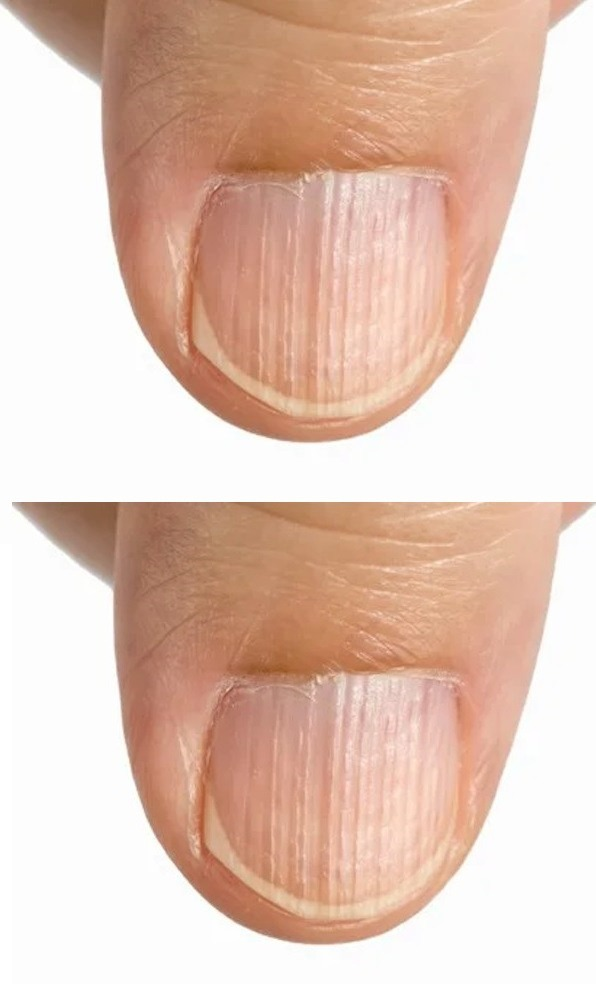 Doctor Explains What It Means If You Have Ridges On Your Fingernails