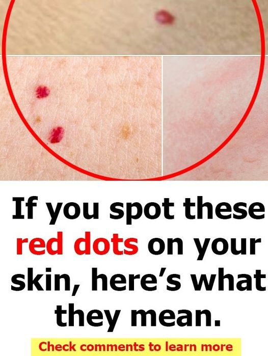 If you spot these red dots on your skin, here’s what they mean