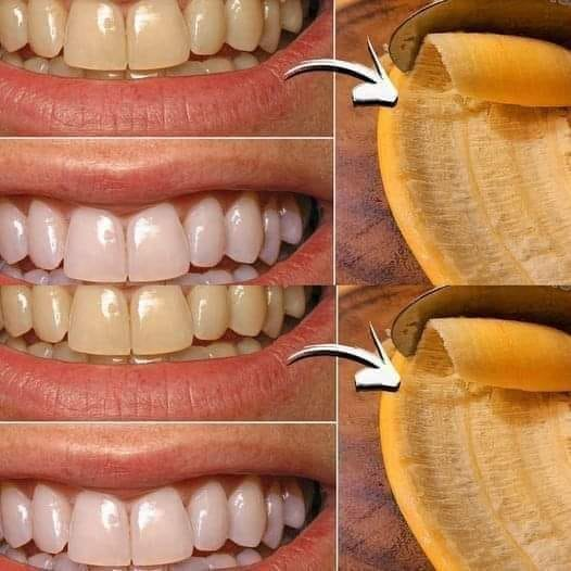 Secret that Dentists don’t want you to know Remove Tartar and Teeth Whitening in just 2 minutes