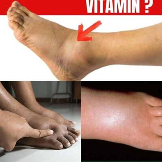 No.1 Vitamin for Removing Leg and Foot Swelling!