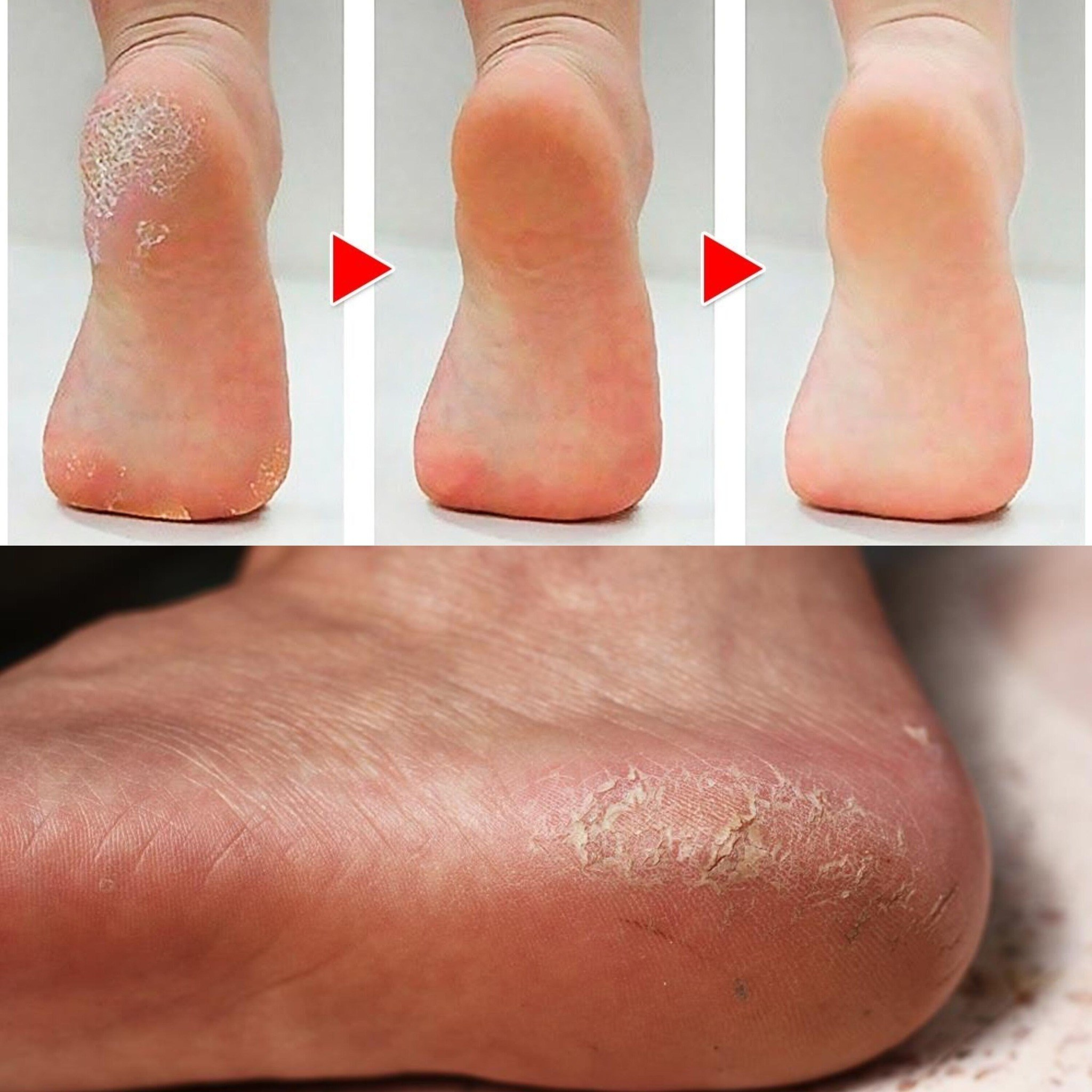 How to Get Rid of Calluses on Feet Naturally